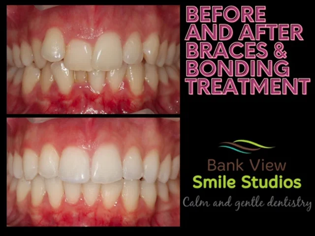 Clinical case: before and after - Whitesmile Clear Aligner - The Clear and  Affordable Invisible Braces