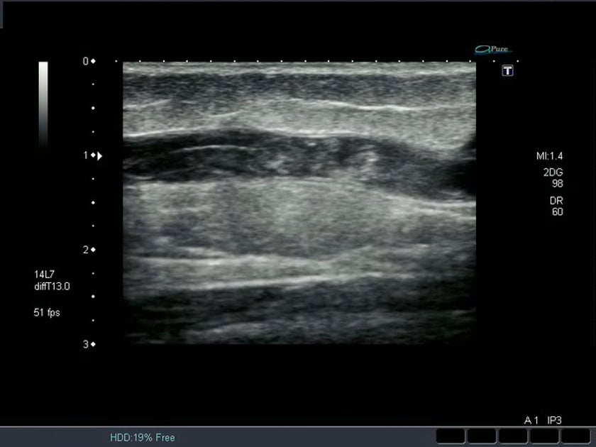 Leg DVT pathology – ULTRASOUNDPAEDIA