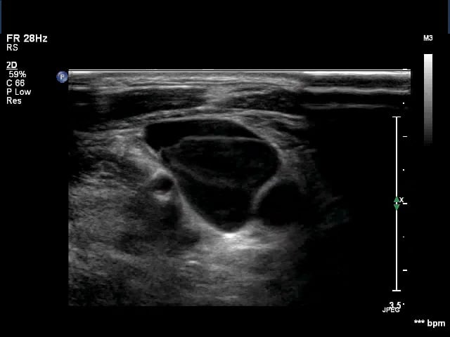 Venous Incompetence – ULTRASOUNDPAEDIA