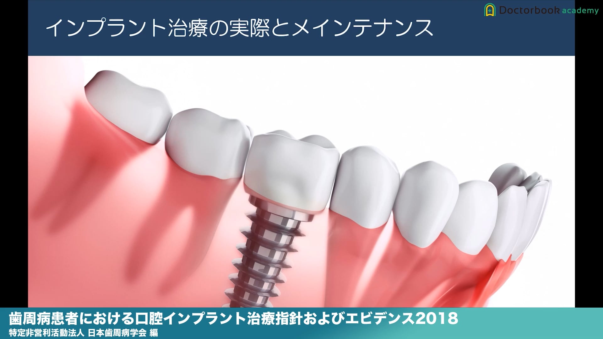 『歯周病患者における口腔インプラント治療指針およびエビデンス2018』解説 Part1