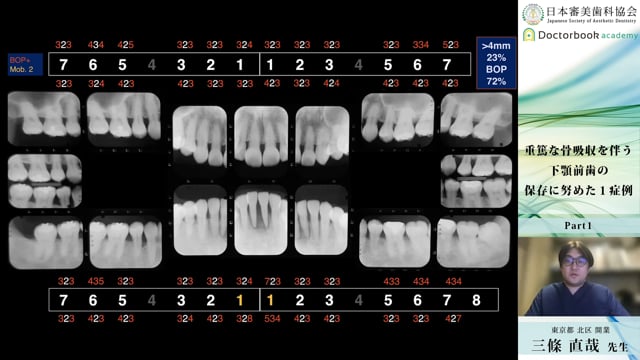 【日本審美歯科協会 WEB講演会】重篤な骨吸収を伴う下顎前歯の保存に努めた１症例