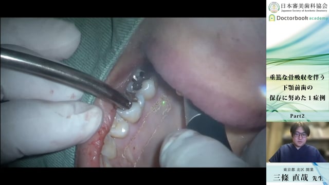 #2 遊離歯肉移植術