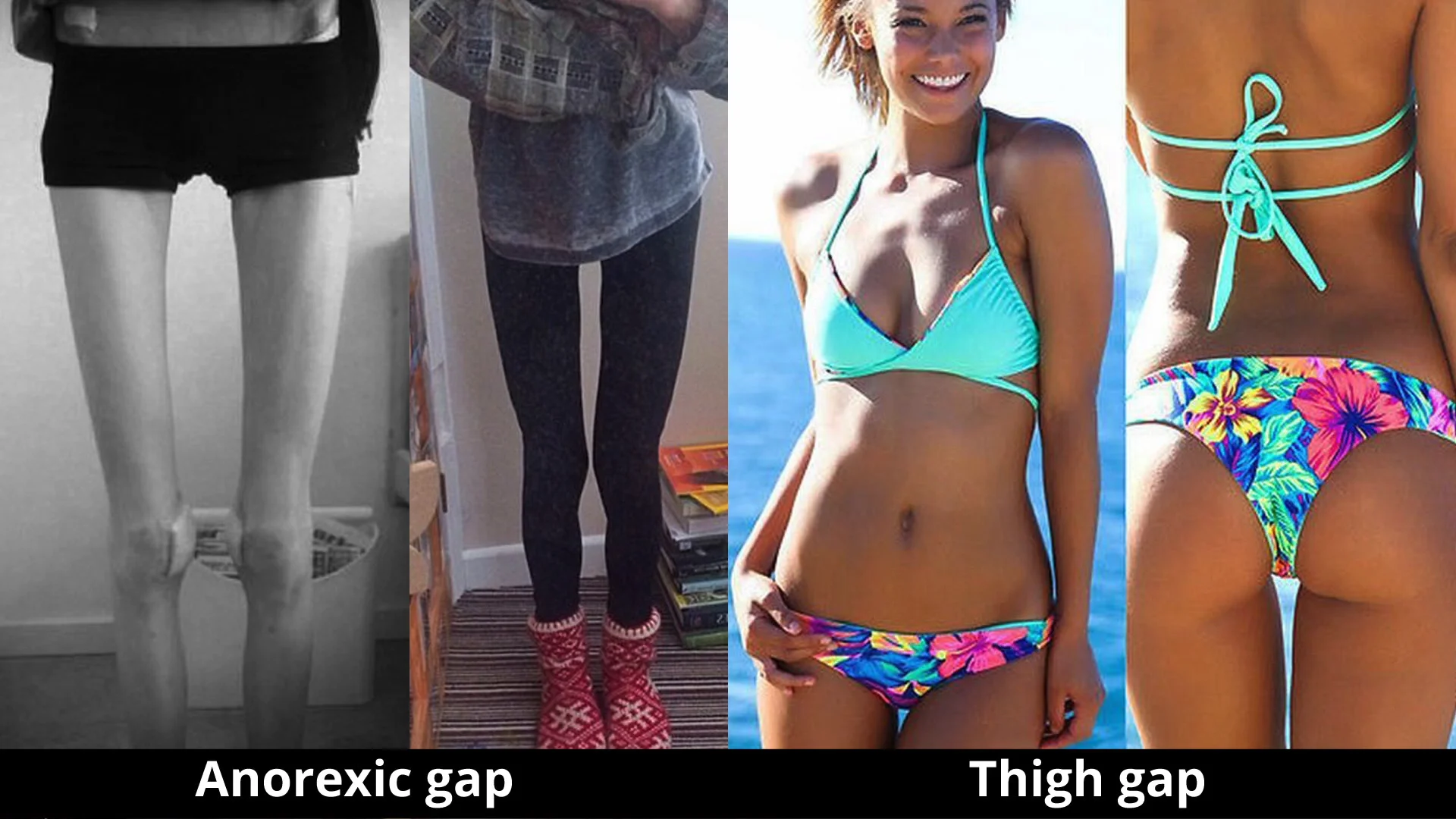The “Thigh Gap”
