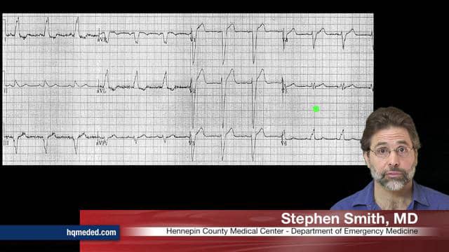 LAD occlusion in the setting of LBBB diagnosed by serial ECGs on Vimeo