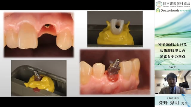 【日本審美歯科協会 WEB講演会】審美領域における抜歯即時埋入の適応とその利点