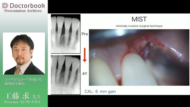 マイクロスコープを用いた歯周再生療法