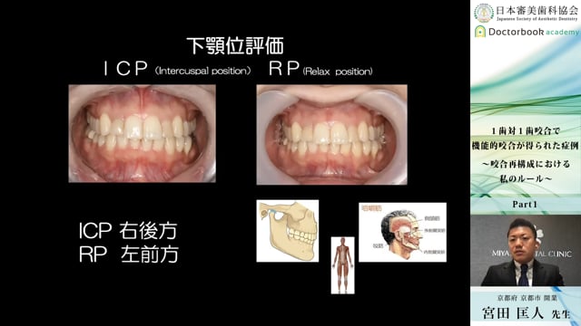 【日本審美歯科協会 WEB講演会】１歯対１歯咬合で機能的咬合が得られた症例 〜咬合再構成における私のルール〜