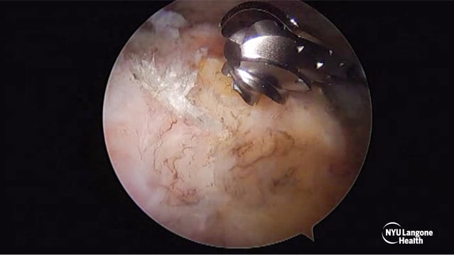 Arthroscopic Tuberoplasty for Irreparable Rotator Cuff Tear