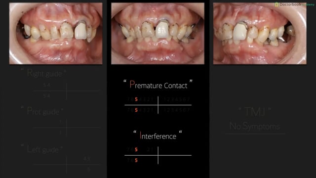 上下歯列弓幅径の大きく異なる患者に咬合再構成を行った一症例