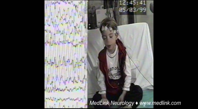 Typical absence seizures of idiopathic myoclonic