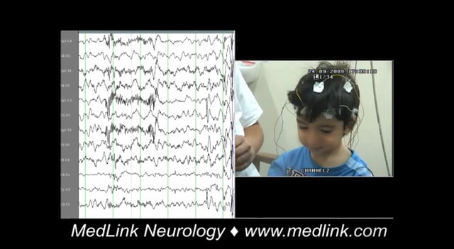 Typical absence seizures of idiopathic myoclonic