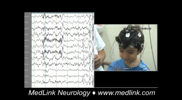 Idiopathic generalized epilepsy with typical