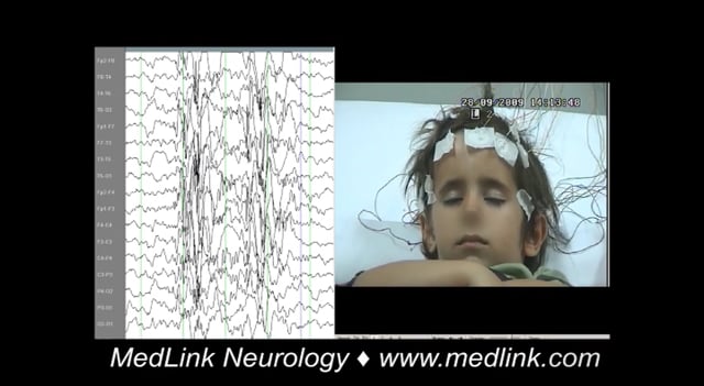 Idiopathic generalized epilepsy with typical