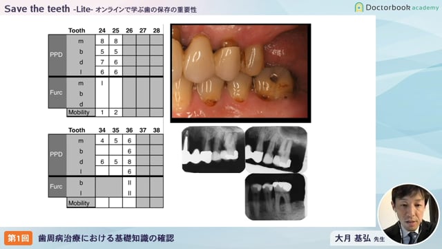 Save the teeth−Lite−オンラインで学ぶ歯の保存の重要性 「第一回：歯周病治療における基礎知識の確認」