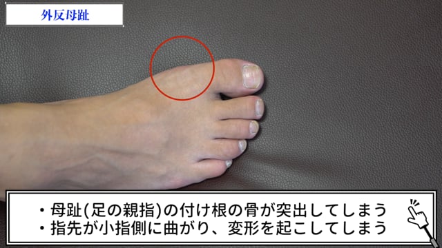 症例別『外反母趾』