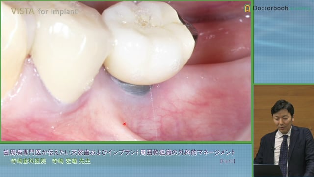 #5 遊離歯肉移植術と治癒のバイオロジー