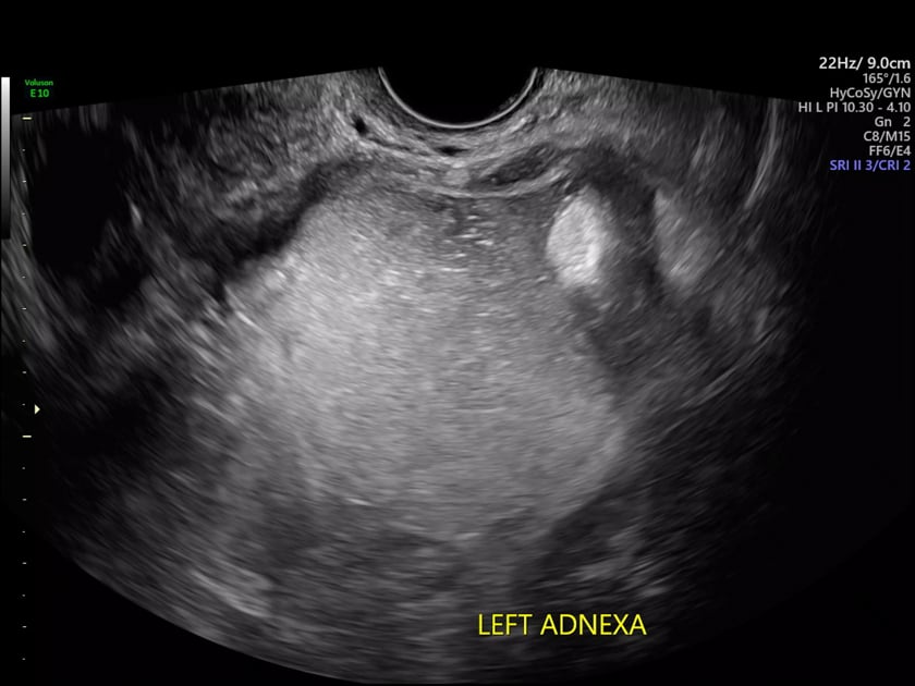 simple ovarian cyst ultrasound