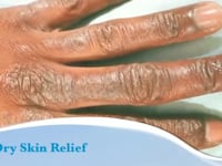 Dry Skin