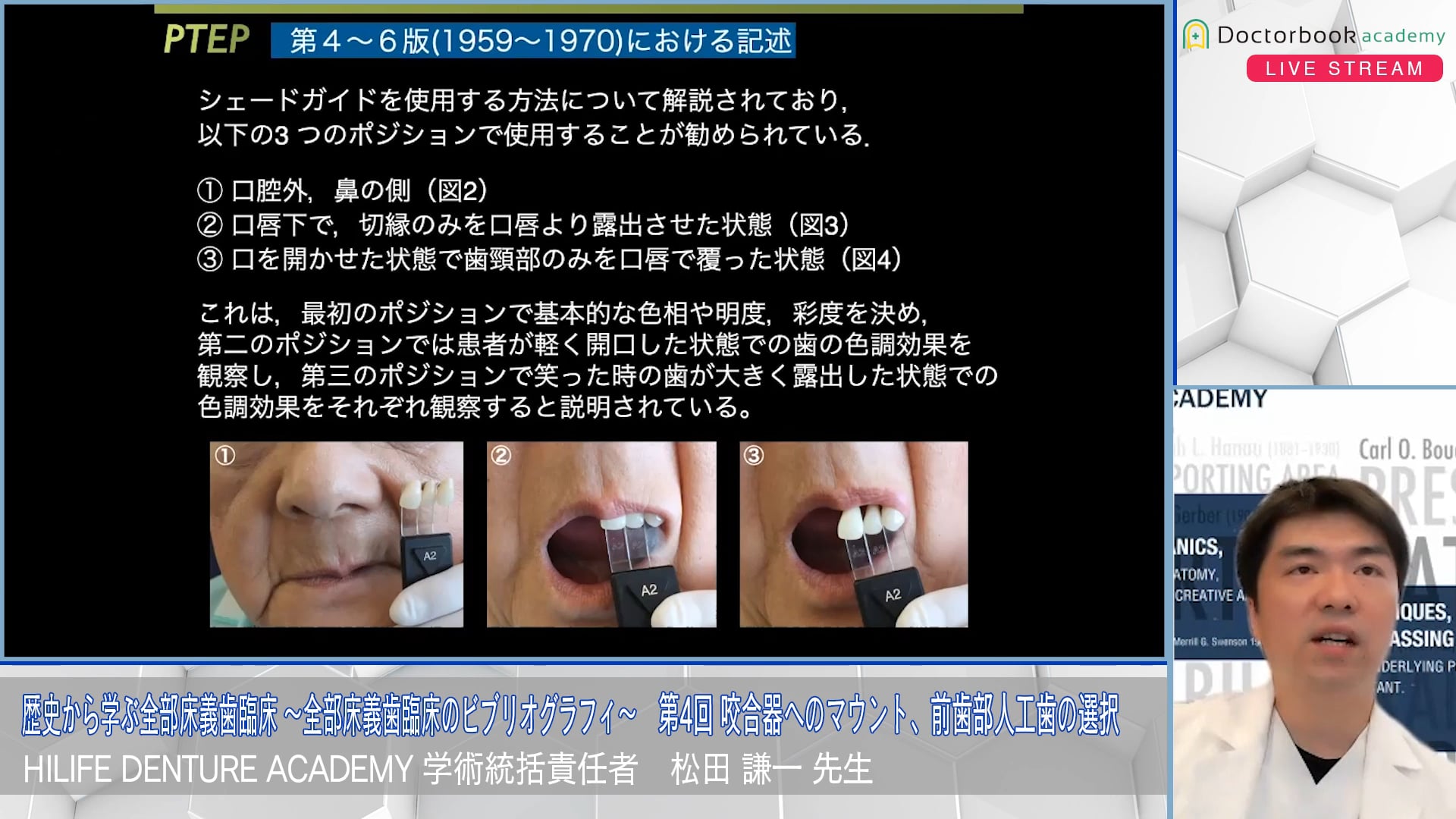 咬合器へのマウント、前歯部人工歯の選択│歴史から学ぶ全部床義歯臨床 〜全部床義歯臨床のビブリオグラフィ〜 第4回