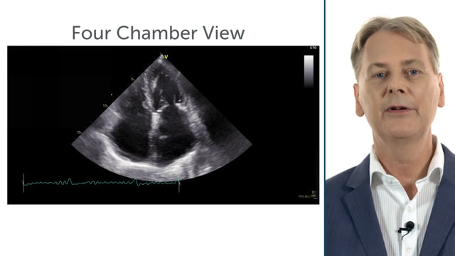 Case: patient with dilated atria