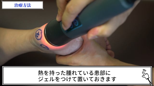 症例別『踵骨骨端症』