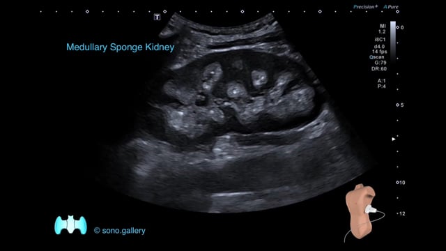 Medullary Sponge Kidney
