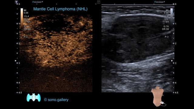 Mantle Cell Lymphoma (NHL)