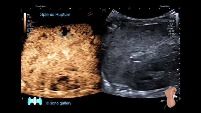 Splenic Rupture