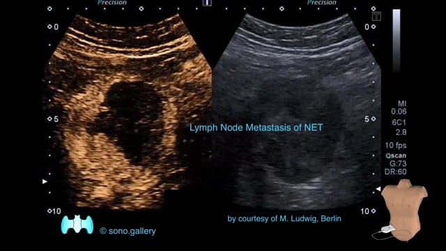 Lymph Node Metastasis of NET