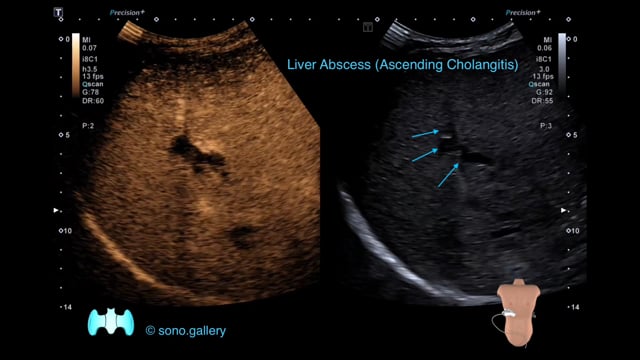 Liver Abscess (Ascending Cholangitis)