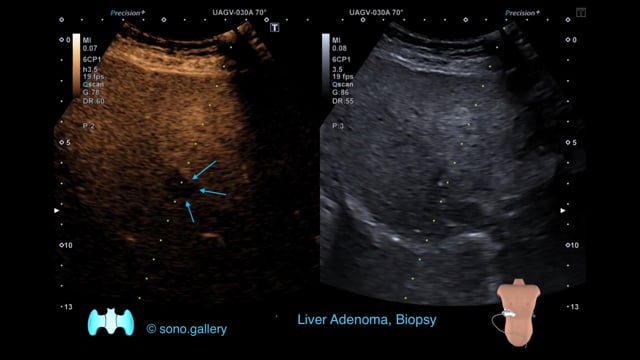 Liver Adenoma, Biopsy
