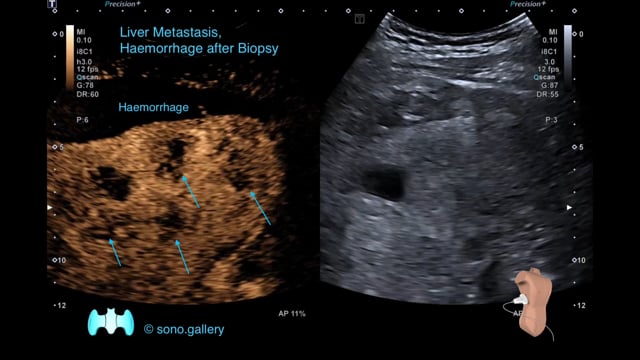 Liver Metastasis, Haemorrhage after Biopsy