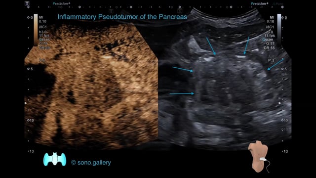 Inflammatory Pseudotumor of the Pancreas
