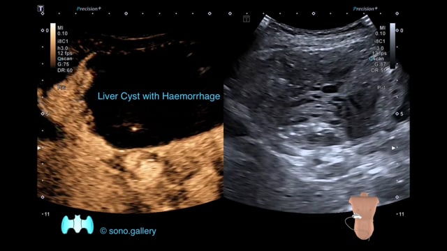 Liver Cyst with Haemorrhage