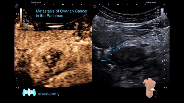 Metastasis of Ovarian Cancer in the Pancreas