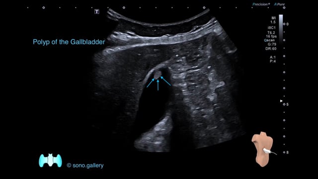 Polyp of the Gallbladder