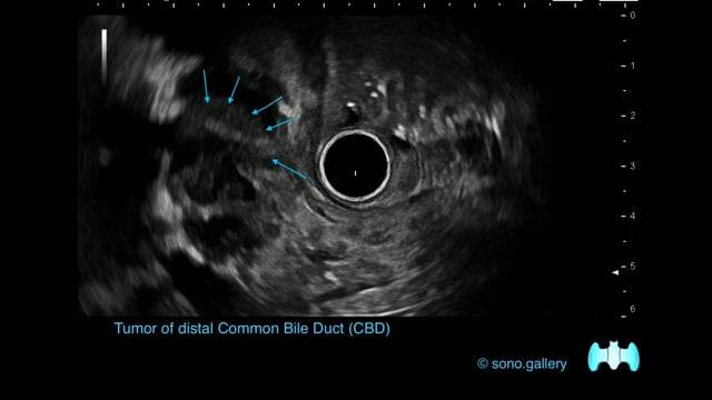 Tumor of distal Common Bile Duct (CBD)