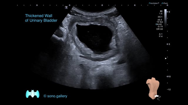 Thickened Wall of Urinary Bladder