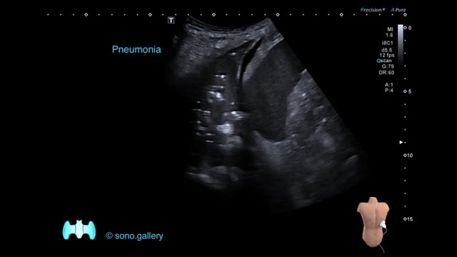Pneumonia