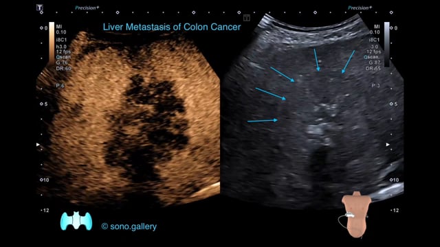 Liver Metastasis of Colon Cancer