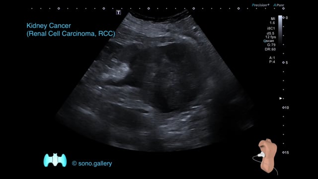 Kidney Cancer (Renal Cell Carcinoma, RCC)