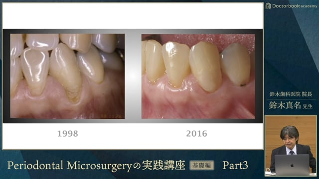 Periodontal Microsurgeryの実践講座 | Doctorbook academy (ドクター