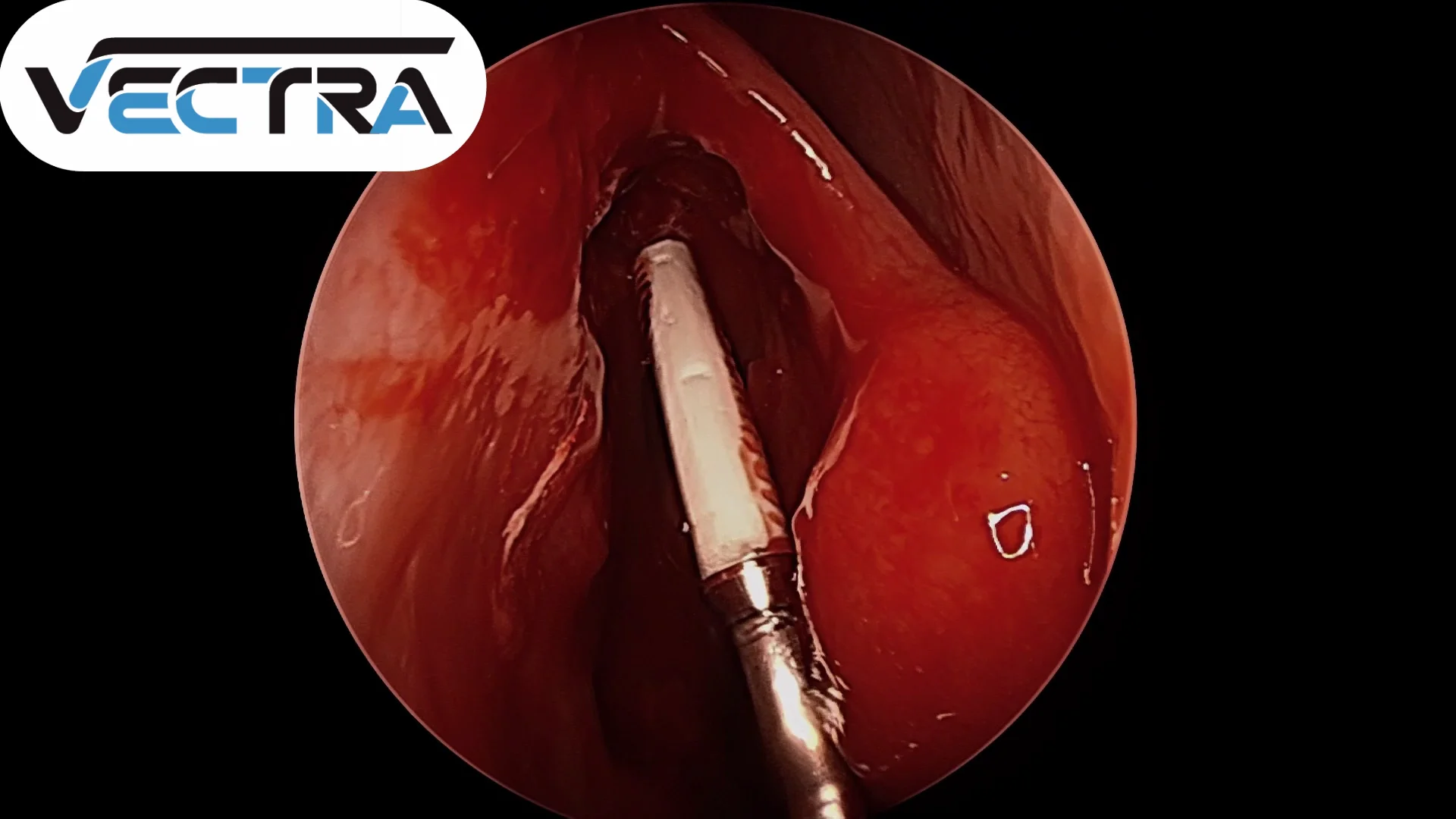 VECTRA Surgical Video