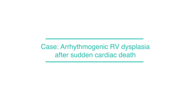 Case: Arrhythmogenic RV dysplasia after sudden cardiac death