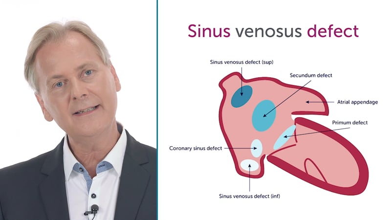 What is a sinus venosus defect?