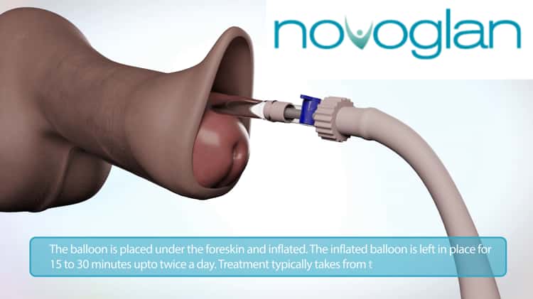 Novoglan  Phimosis Treatment