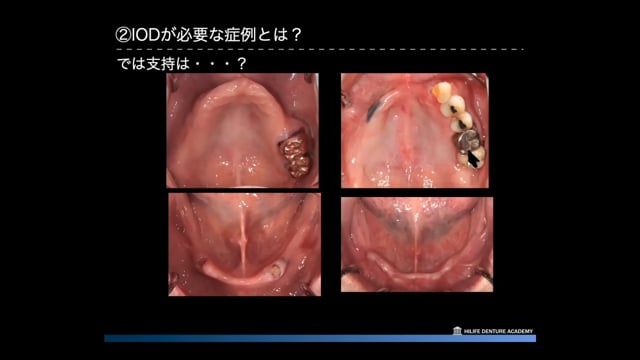 #1 無歯顎患者へのIOD応用  〜IODとCDの違い、IODが必要な症例とは？〜