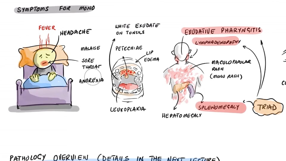 Epstein Barr Virus (EBV) - Long COVID