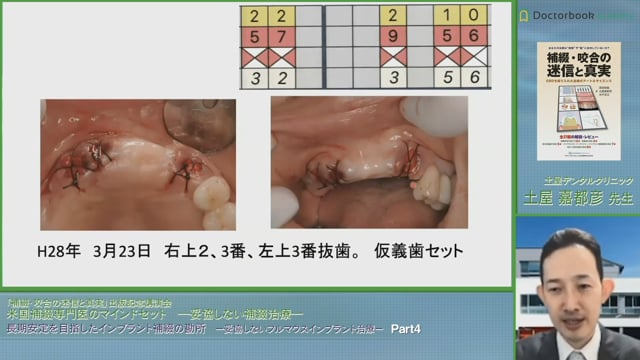 #4 インプラント傾斜埋入の利点