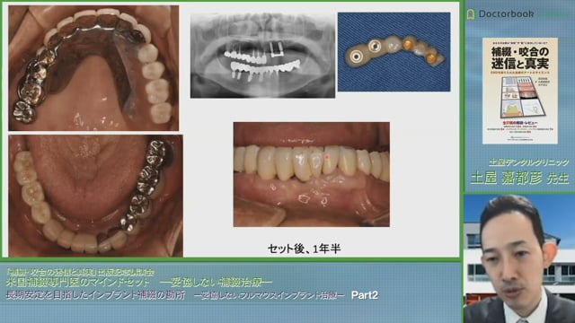 長期安定を目指したインプラント補綴の勘所 - 妥協しないフルマウス 